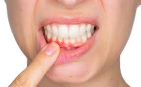 bleeding gums due to vitamin c defciency