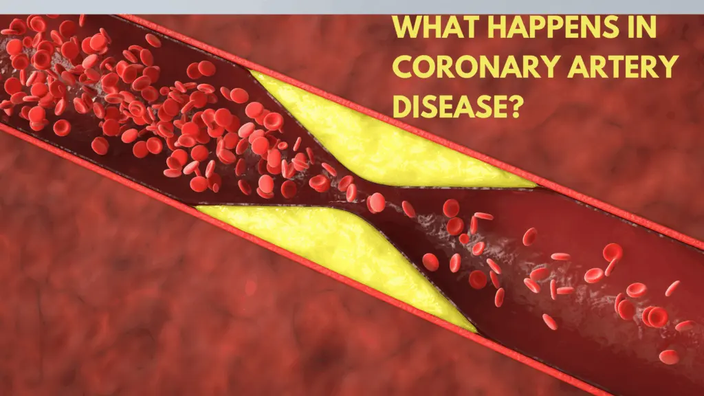 What Happens in Coronary Artery Disease?