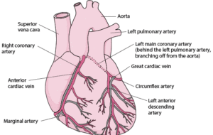 coronary artery disease